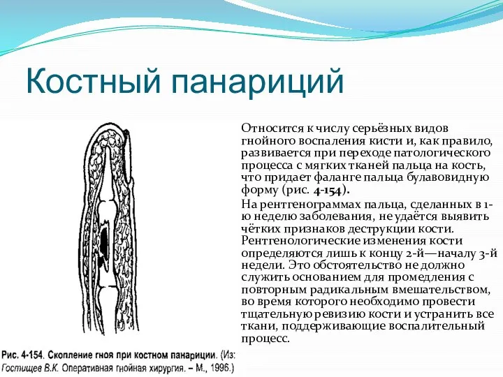 Костный панариций Относится к числу се­рьёзных видов гнойного воспаления кисти и, как