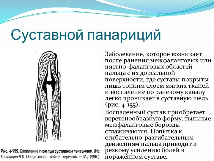 Суставной панариций Заболевание, ко­торое возникает после ранения межфаланговых или пястно-фаланговых областей пальца