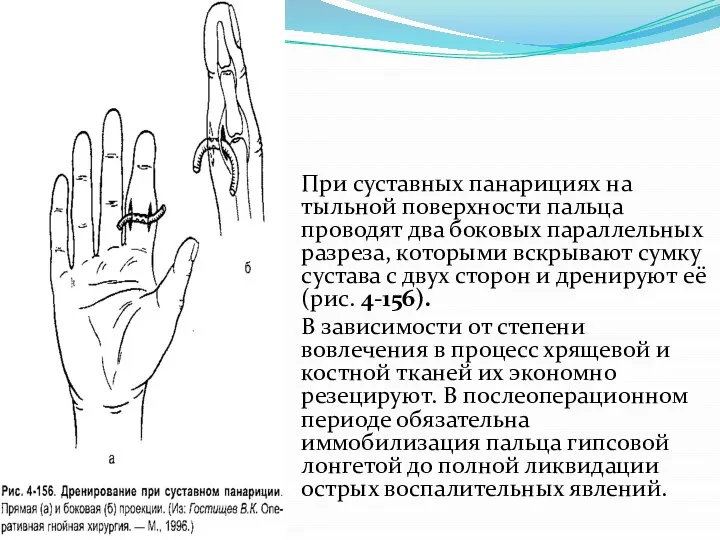 При суставных панарициях на тыльной по­верхности пальца проводят два боковых па­раллельных разреза,