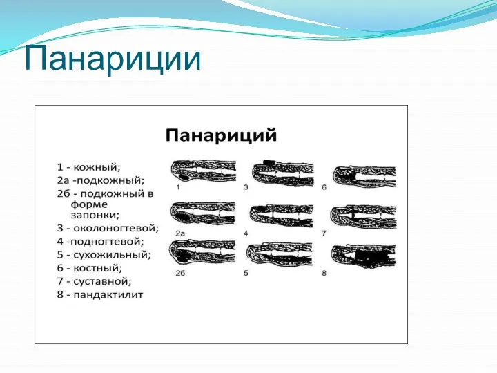 Панариции