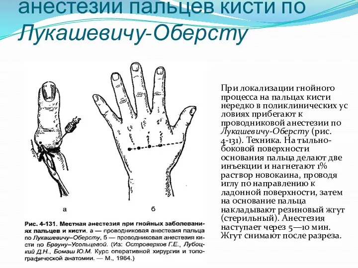 Техника проводниковой анестезии пальцев кисти по Лукашевичу-Оберсту При локализации гнойного процесса на
