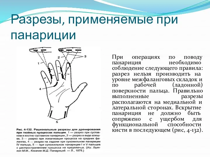 Разрезы, применяемые при панариции При операциях по поводу панариция необ­ходимо соблюдение следующего