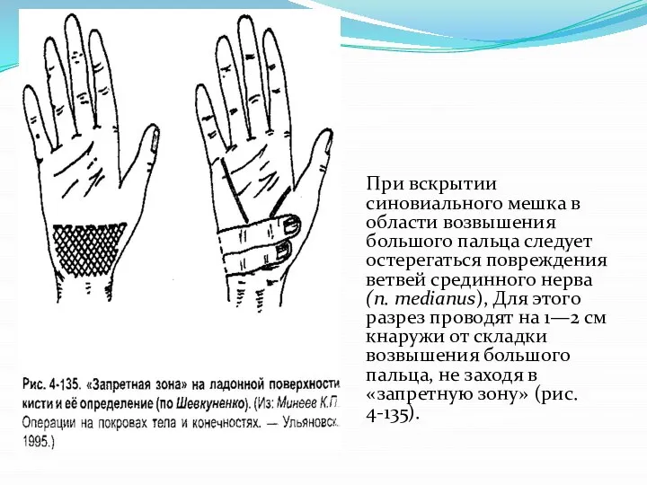 При вскры­тии синовиального мешка в области возвы­шения большого пальца следует остерегаться повреждения