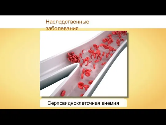 Наследственные заболевания Серповидноклеточная анемия