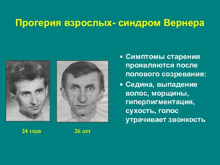 Прогерия взрослых- синдром Вернера Симптомы старения проявляются после полового созревания: Седина, выпадение