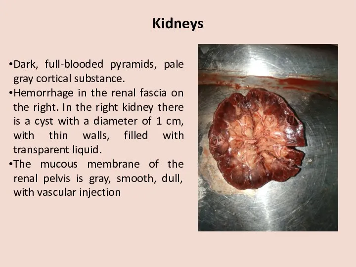 Kidneys Dark, full-blooded pyramids, pale gray cortical substance. Hemorrhage in the renal