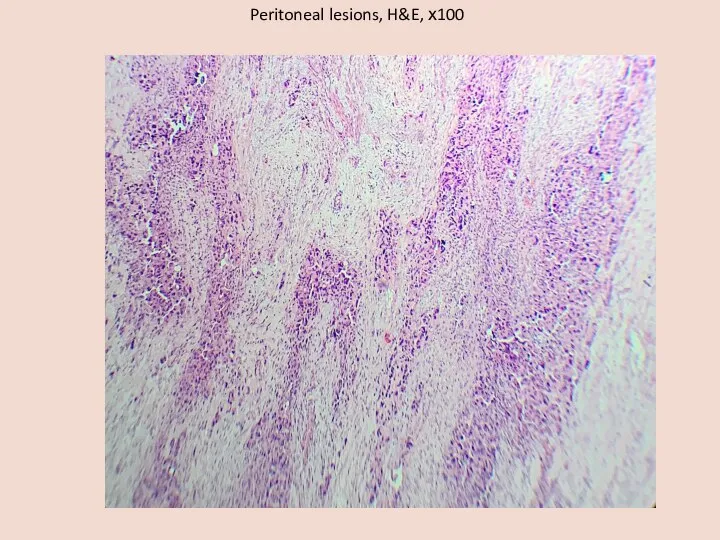 Peritoneal lesions, H&E, х100