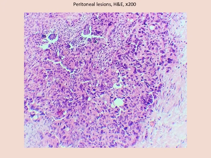 Peritoneal lesions, H&E, х200