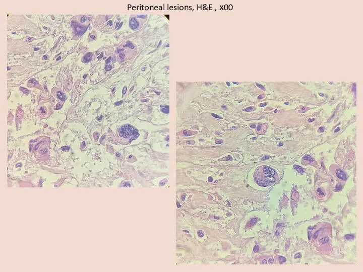 Peritoneal lesions, H&E , х00