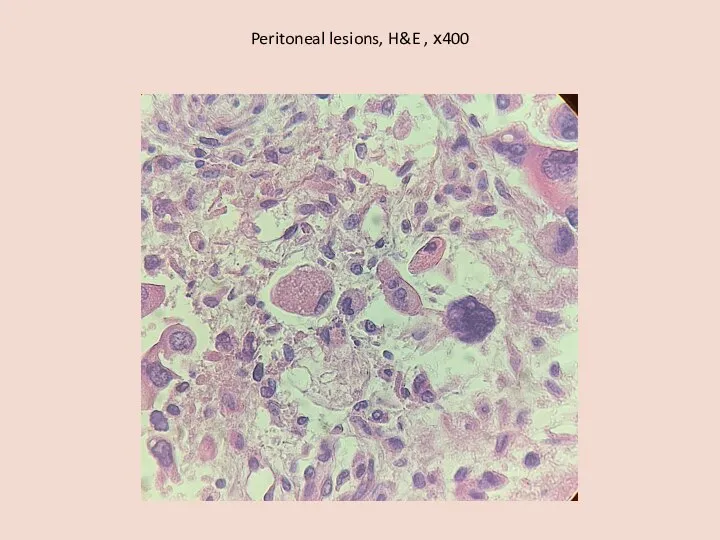 Peritoneal lesions, H&E , х400