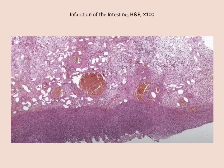 Infarction of the Intestine, H&E, х100