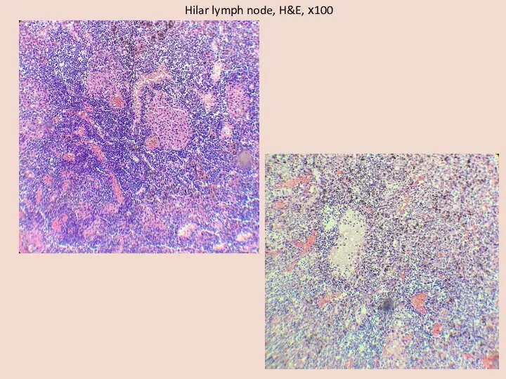 Hilar lymph node, H&E, х100