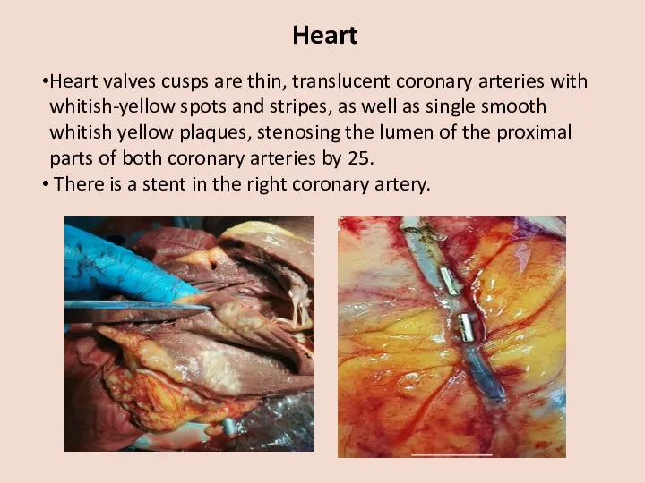 Heart Heart valves cusps are thin, translucent coronary arteries with whitish-yellow spots