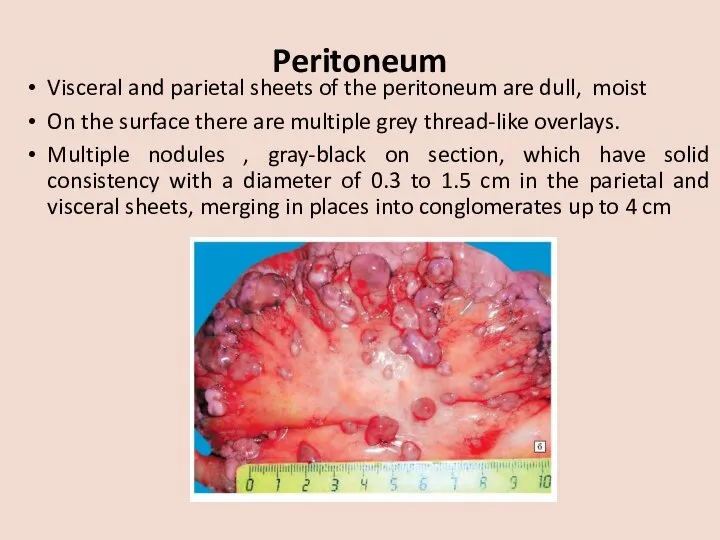 Peritoneum Visceral and parietal sheets of the peritoneum are dull, moist On