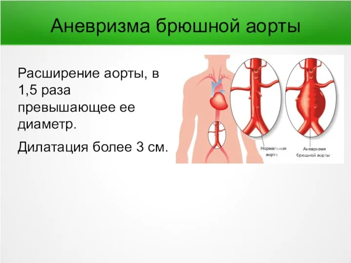 Аневризма брюшной аорты Расширение аорты, в 1,5 раза превышающее ее диаметр. Дилатация более 3 см.