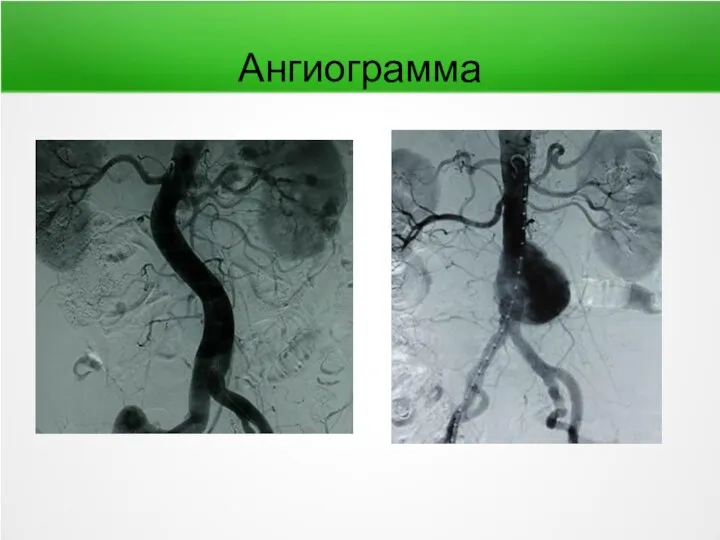 Ангиограмма