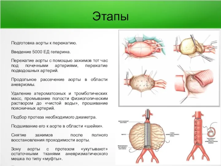 Этапы Подготовка аорты к пережатию. Введение 5000 ЕД гепарина. Пережатие аорты с