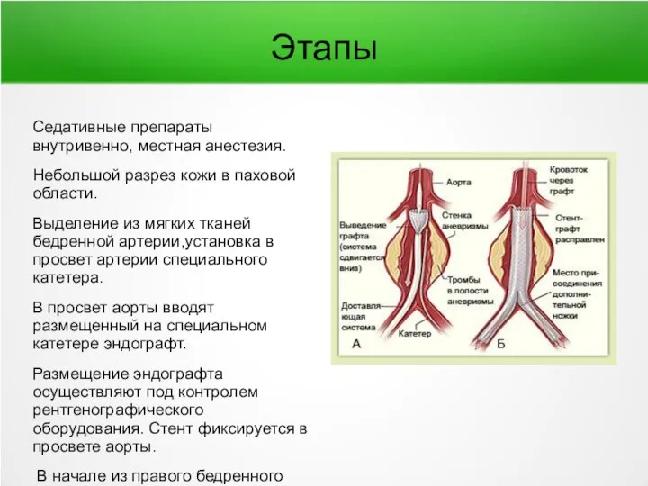 Этапы Седативные препараты внутривенно, местная анестезия. Небольшой разрез кожи в паховой области.