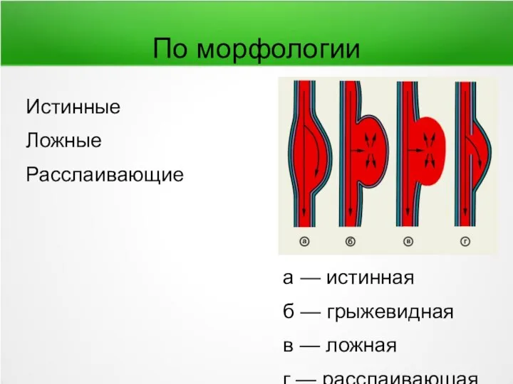 Истинные Ложные Расслаивающие По морфологии а — истинная б — грыжевидная в