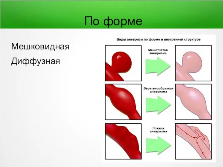 По форме Мешковидная Диффузная