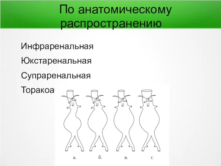 По анатомическому распространению Инфраренальная Юкстаренальная Супраренальная Торакоабдоминальная