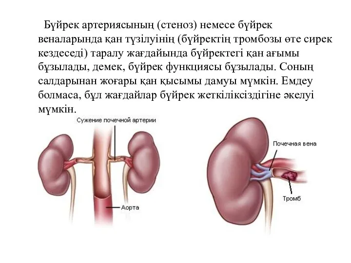 Бүйрек артериясының (стеноз) немесе бүйрек веналарында қан түзілуінің (бүйректің тромбозы өте сирек