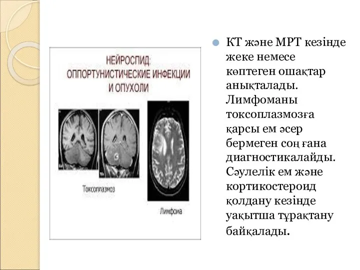 КТ және МРТ кезінде жеке немесе көптеген ошақтар анықталады.Лимфоманы токсоплазмозға қарсы ем