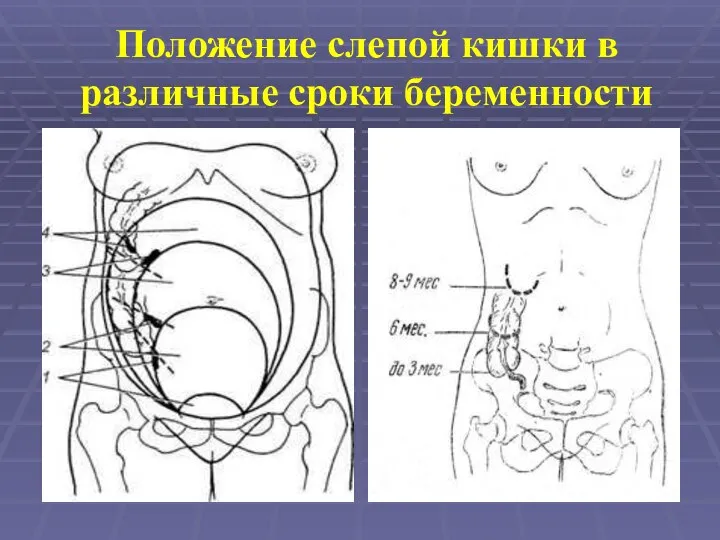 Положение слепой кишки в различные сроки беременности