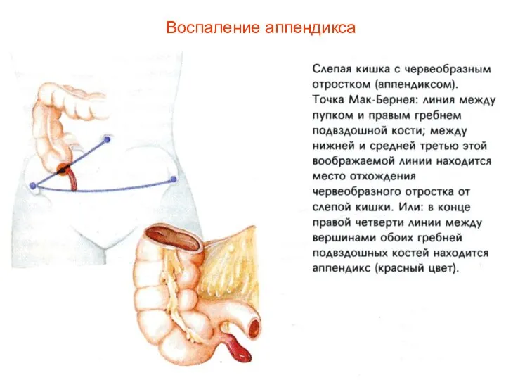 Воспаление аппендикса