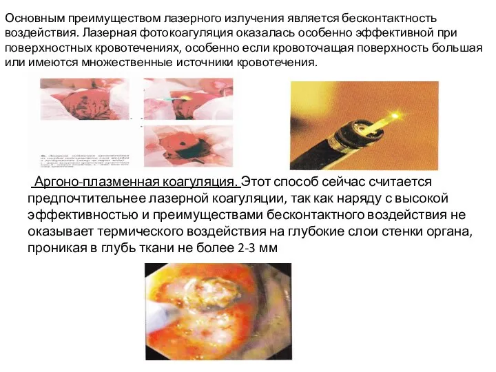 Аргоно-плазменная коагуляция. Этот способ сейчас считается предпочтительнее лазерной коагуляции, так как наряду