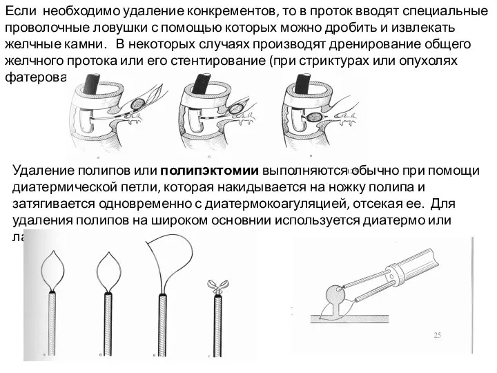 Если необходимо удаление конкрементов, то в проток вводят специальные проволочные ловушки с
