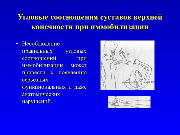 Угловые соотношения суставов верхней конечности при иммобилизации Несоблюдение правильных угловых соотношений при