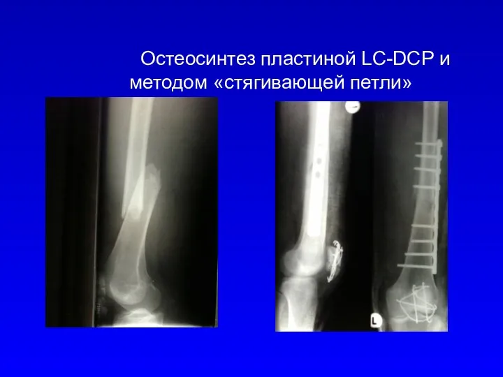 Остеосинтез пластиной LC-DCP и методом «стягивающей петли»