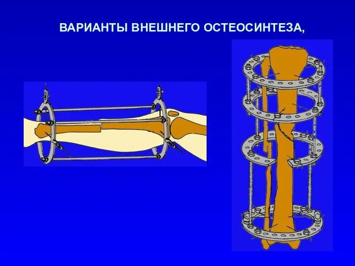 ВАРИАНТЫ ВНЕШНЕГО ОСТЕОСИНТЕЗА,