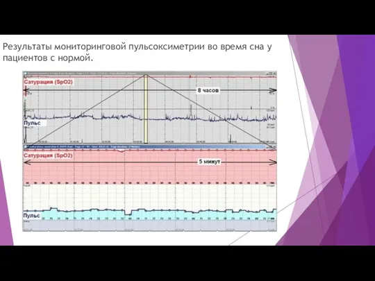 Результаты мониторинговой пульсоксиметрии во время сна у пациентов с нормой.