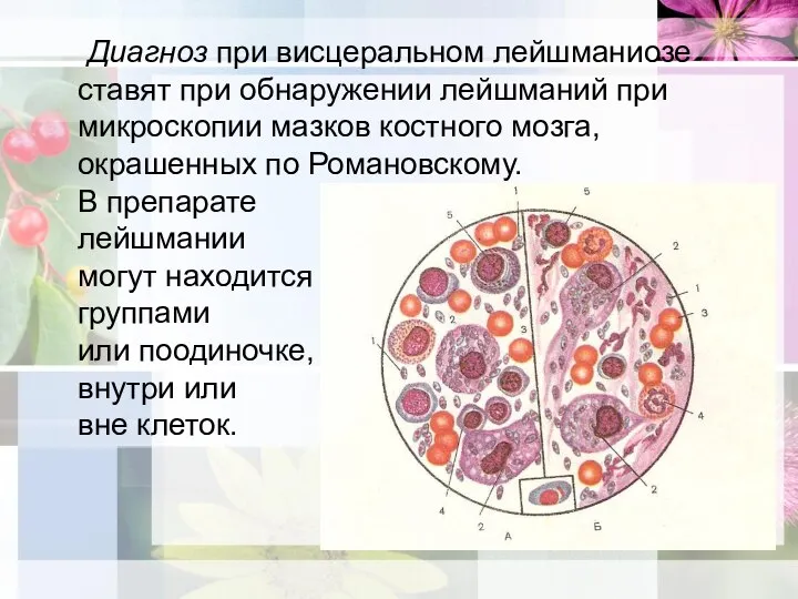 Диагноз при висцеральном лейшманиозе ставят при обнаружении лейшманий при микроскопии мазков костного