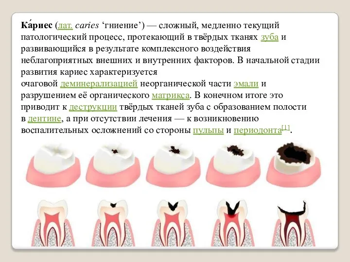 Ка́риес (лат. caries ‘гниение’) — сложный, медленно текущий патологический процесс, протекающий в