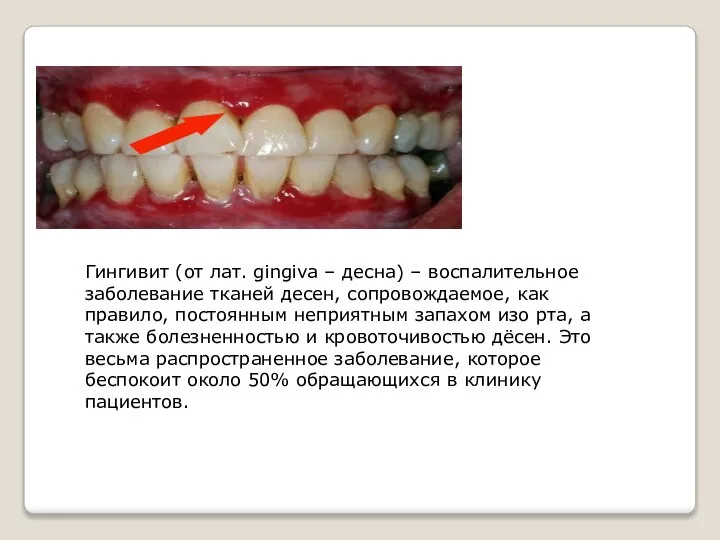 Гингивит (от лат. gingiva – десна) – воспалительное заболевание тканей десен, сопровождаемое,