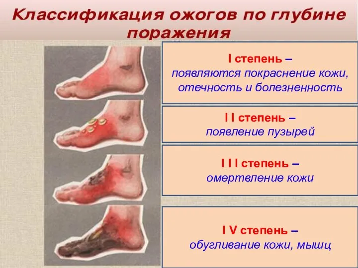 I степень – появляются покраснение кожи, отечность и болезненность I I степень