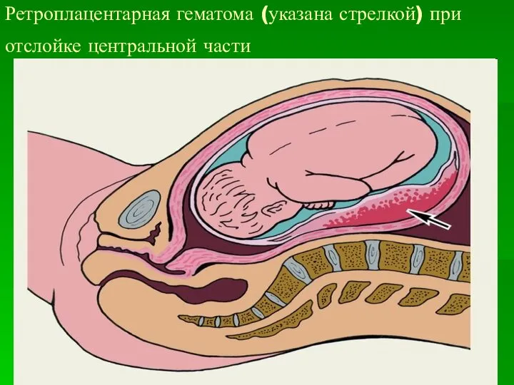 Ретроплацентарная гематома (указана стрелкой) при отслойке центральной части