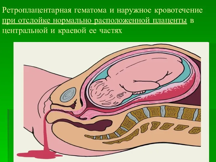 Ретроплацентарная гематома и наружное кровотечение при отслойке нормально расположенной плаценты в центральной и краевой ее частях