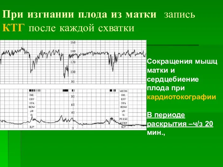 Сокращения мышц матки и сердцебиение плода при кардиотокографии В периоде раскрытия –ч/з