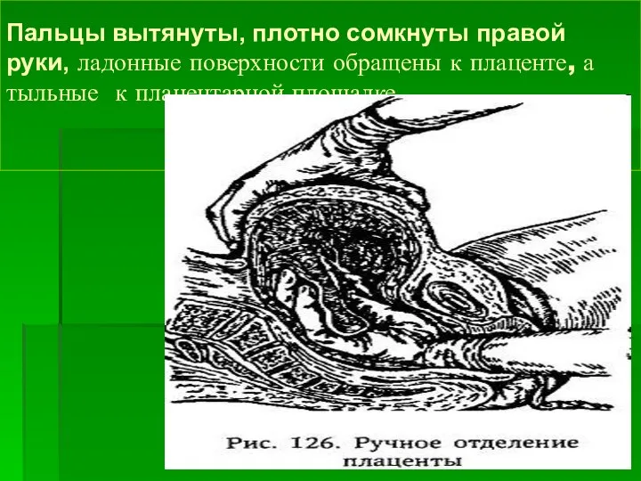 Пальцы вытянуты, плотно сомкнуты правой руки, ладонные поверхности обращены к плаценте, а тыльные к плацентарной площадке.