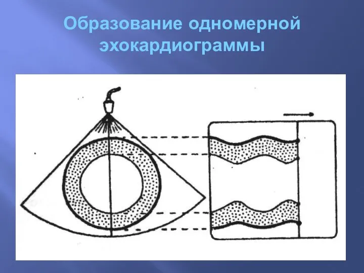 Образование одномерной эхокардиограммы