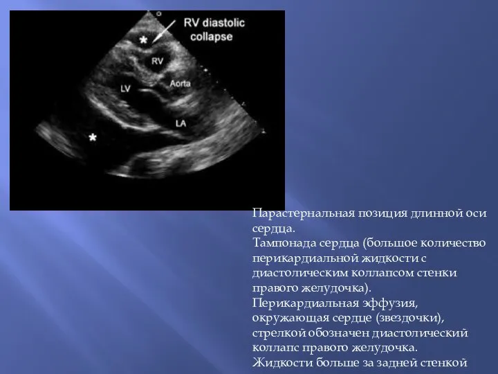 Парастернальная позиция длинной оси сердца. Тампонада сердца (большое количество перикардиальной жидкости с