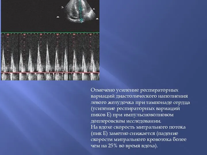 Отмечено усиление респираторных вариаций диастолического наполнения левого желудочка при тампонаде сердца (усиление