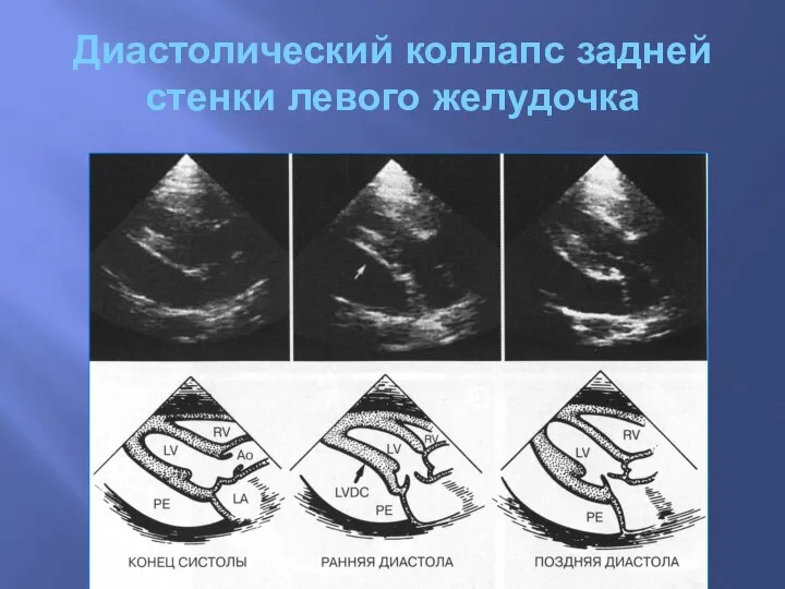 Диастолический коллапс задней стенки левого желудочка