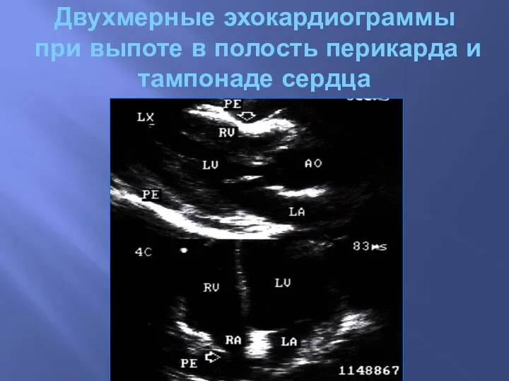 Двухмерные эхокардиограммы при выпоте в полость перикарда и тампонаде сердца