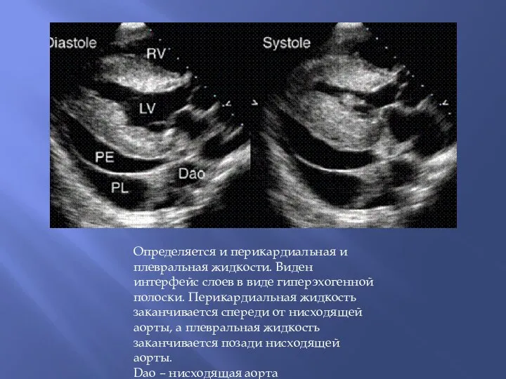 Определяется и перикардиальная и плевральная жидкости. Виден интерфейс слоев в виде гиперэхогенной