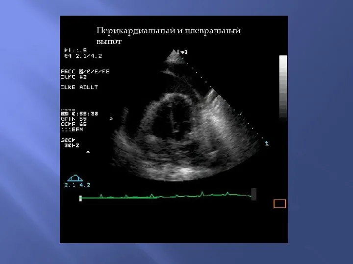 Перикардиальный и плевральный выпот